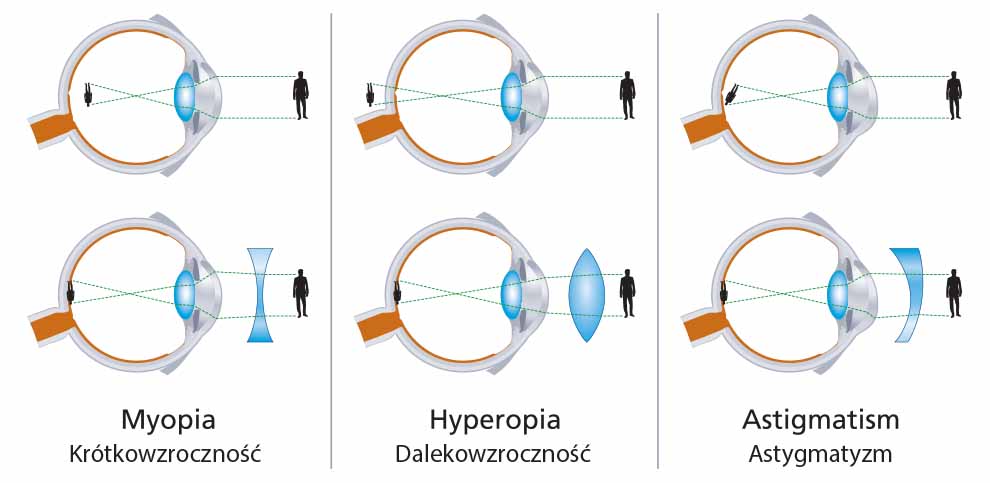 astygmatyzm, krókowzroczność i dalekowzroczność